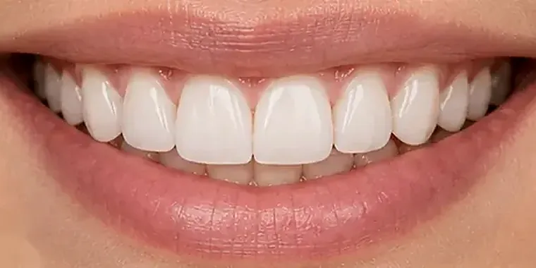 A natural, evenly shaded smile after cosmetic treatment