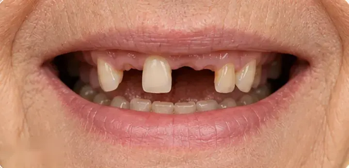 Before: several missing teeth across the upper arch