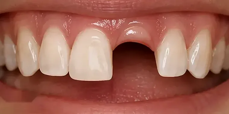 A missing upper front tooth after a fracture