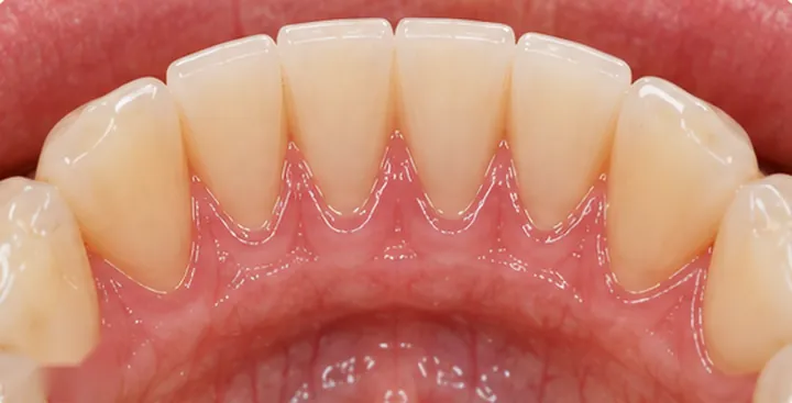 After: clean tooth surfaces and calm, healthy gum tissue
