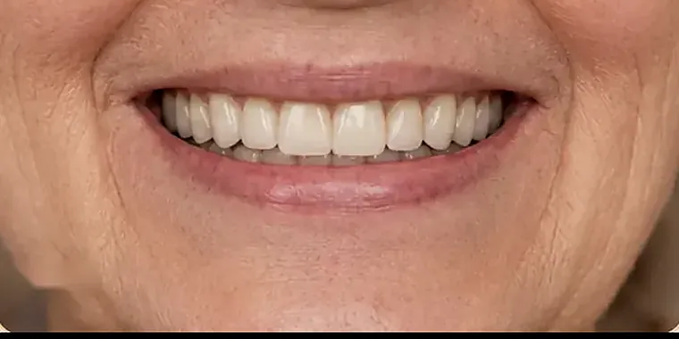 A dental implant shown in position in the jaw