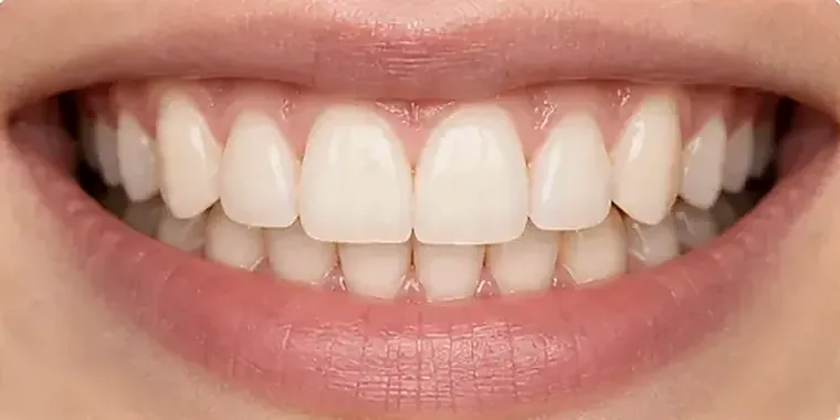 An aligned upper arch after clear aligner treatment