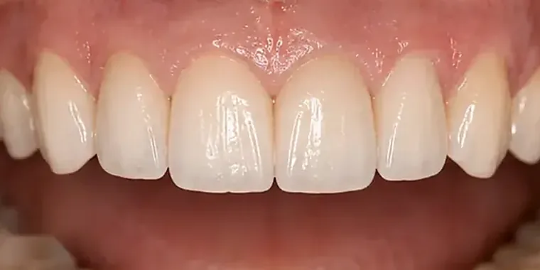 Close view of porcelain restorations on the upper front teeth